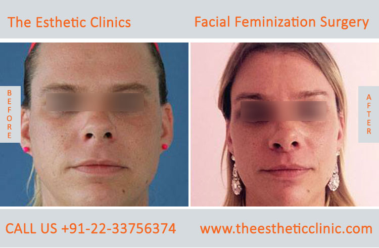 Facial Feminization Surgery before after photos in mumbai india (3)